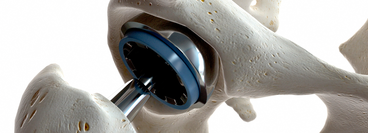 An artifical hip joint